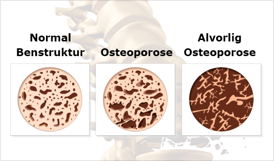 Normal benstruktur og osteoporose