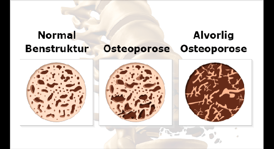 Normal benstruktur og osteoporose